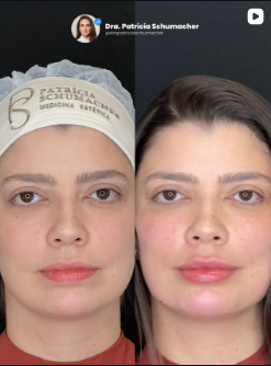 Antes e Depois Toxina Botulínica e Preenchimento