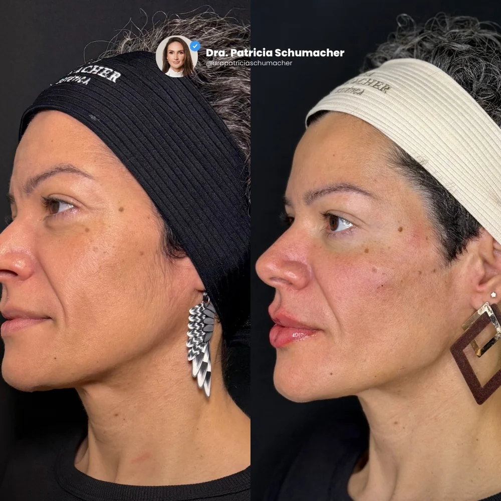 Antes e depois do primeiro procedimento estético, vista de perfil