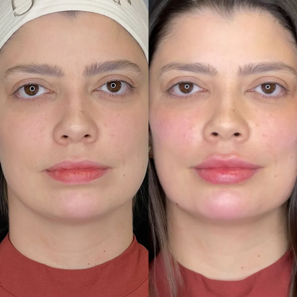 Antes e depois de toxina botulínica e preenchimento, vista frontal