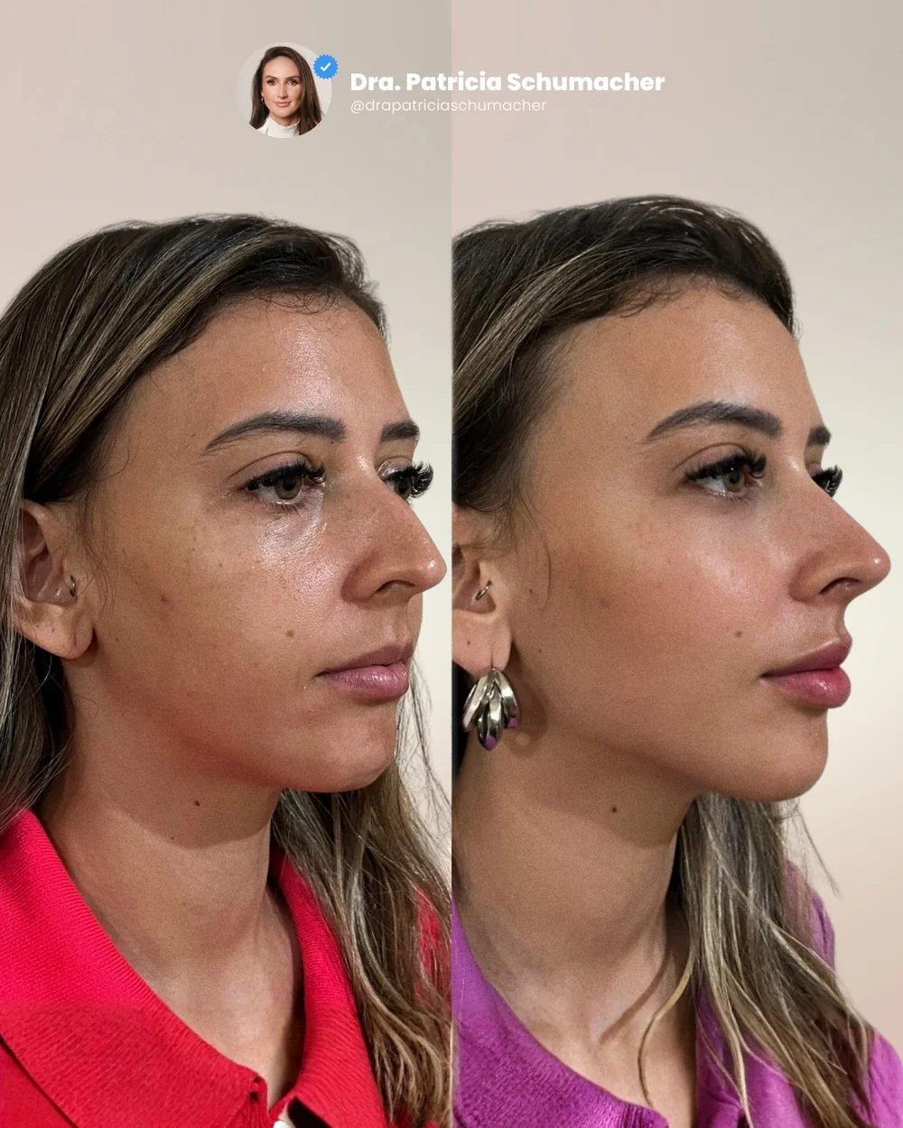 Resultado real de antes e depois de harmonização facial com a Dra. Patrícia Schumacher